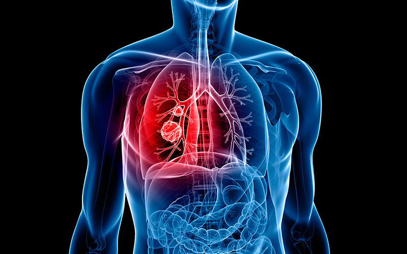 Tratamiento para pacientes con patología pulmonar